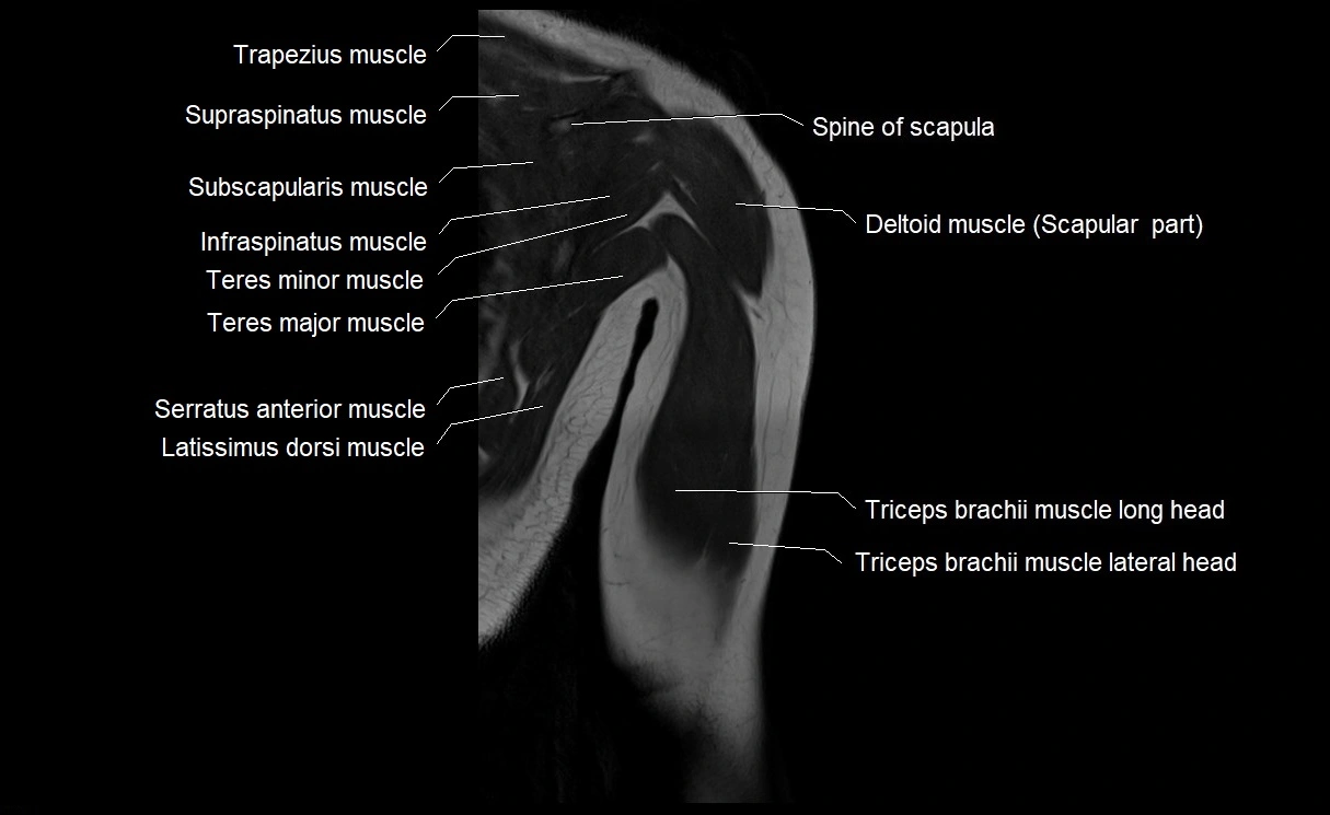 MRI upper arm (humerus ) coronal cross sectional anatomy image 25.webp